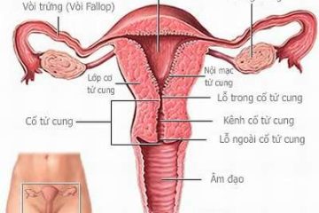 Vô sinh do dị tật tử cung