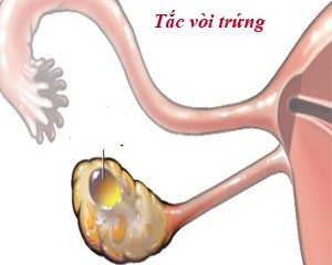 Nguyên nhân bị tắc vòi trứng