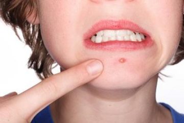 Mụn rộp sinh dục ở nữ giới