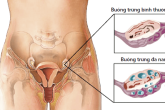 Những điều cần biết về hội chứng buồng trứng đa nang