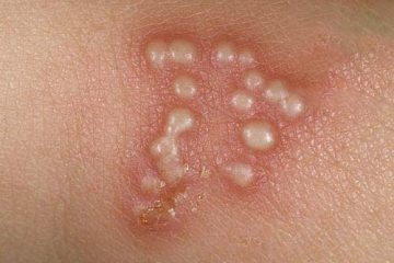 Triệu chứng bệnh mụn rộp sinh dục và cách phòng tránh