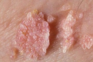 Tổng quan về bệnh sùi mào gà