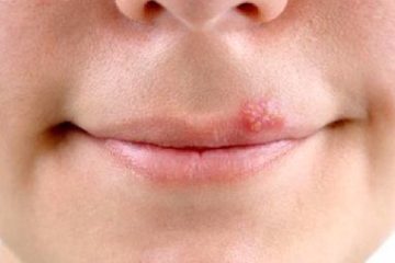 Chữa sùi mào gà ở miệng ở đâu tại TPHCM – Top 6 địa chỉ được nhiều bệnh nhân lựa chọn