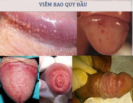Hình ảnh bệnh viêm bao quy đầu Hình ảnh bệnh viêm bao quy đầu