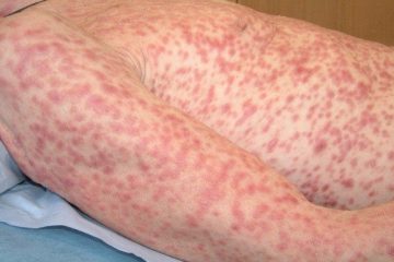 Bệnh giang mai có tái phát không