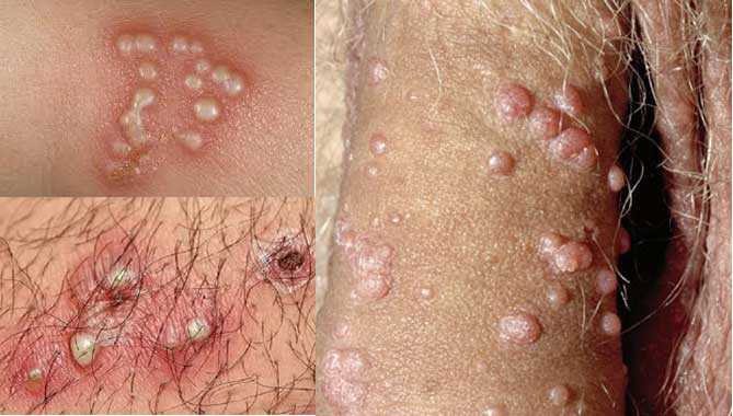 ngua-man-do-co-quan-sinh-duc-nam-co-the-la-bieu-hien-cua-benh-mun-rop-sinh-duc