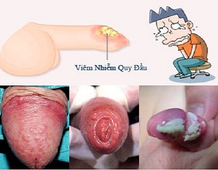 noi-man-do-o-bao-quy-dau-do-viem-nhiem