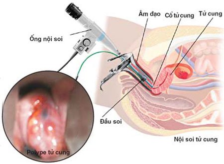 Hình ảnh polyp cổ tử cung