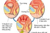 [Tổng Hợp] Các nguyên nhân gây viêm đường tiết niệu cần biết