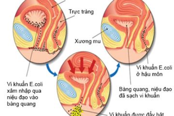 [Tổng Hợp] Các nguyên nhân gây viêm đường tiết niệu cần biết