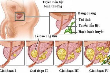 Tác hại phì đại tuyến tiền liệt- [ Có nguy hiểm không ] ?