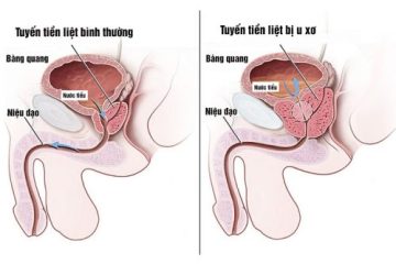 [ Cảnh Báo ] 12+ Nguyên nhân phì đại tuyến tiền liệt anh em cần phải biết