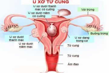Chia sẻ 5+ cách chữa trị u xơ tử cung từ bài thuốc dân gian