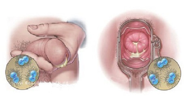 Dấu hiệu bệnh lậu