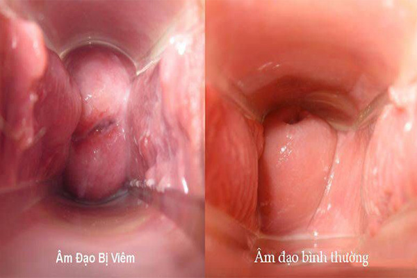 Dấu hiệu viêm âm đạo