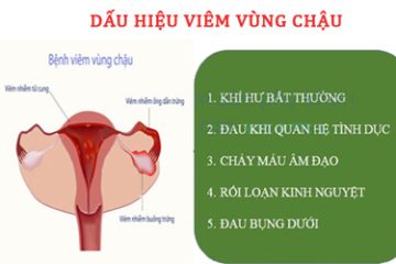 [ Chú ý] 7 + Dấu hiệu viêm vùng chậu thường gặp ở chị em phụ nữ