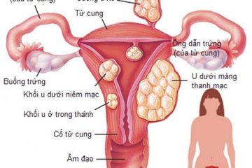 [ Cảnh báo ] 11 + Dấu hiệu u xơ tử cung chị em không được bỏ qua