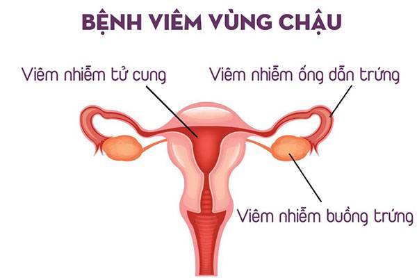 Cách điều trị viêm vùng chậu