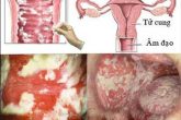 Tác hại viêm âm đạo và những điều chị em phụ nữ cần biết