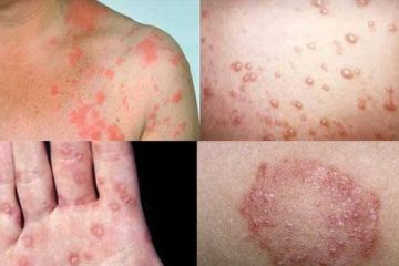 [Tổng hợp] Các cách chữa trị bệnh giang mai