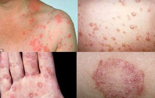 Cách chữa trị bệnh giang mai