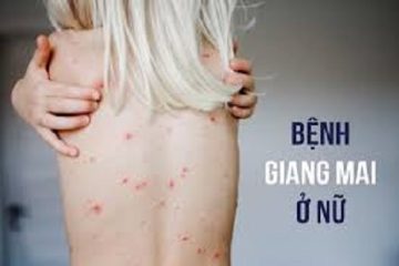 [Cảnh báo] Dấu hiệu bệnh Giang mai – cách điều trị