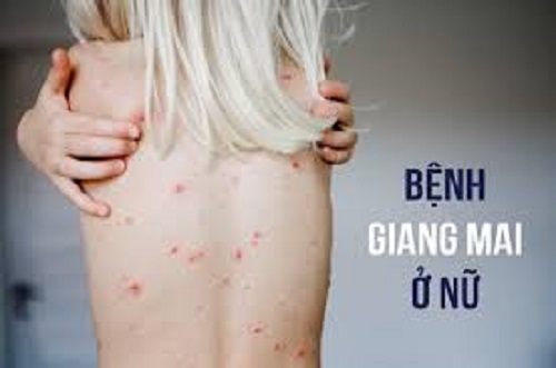 Dấu hiệu bệnh giang mai