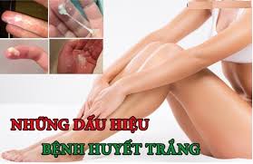 [ Chị em nên biết] 7+ Dấu hiệu bệnh huyết trắng nguy hiểm