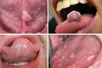 [ Cảnh báo ] 12 + Tác hại Sùi mào gà cực kỳ nguy hiểm bạn cần phải biết