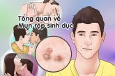 Nguyên nhân mụn rộp sinh dục và cách điều trị mụn rộp sinh dục hiệu quả