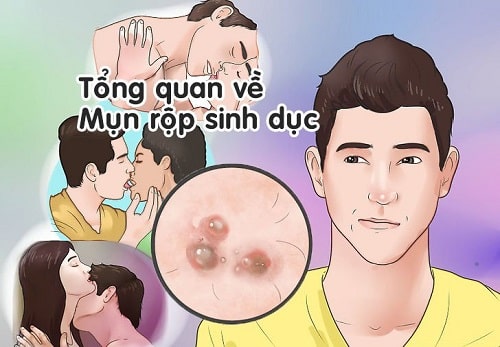 Nguyên nhân mụn rộp sinh dục