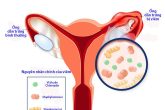[ Điểm mặt ]  4 + Nguyên nhân viêm ống dẫn trứng chị em cần đề phòng