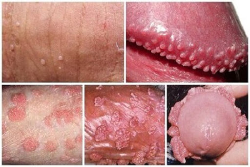 Phương pháp điều trị sùi mào gà