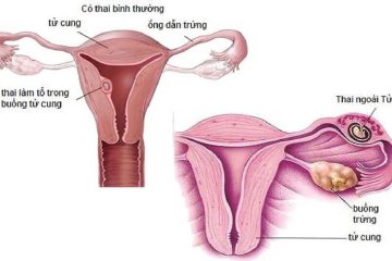 [ Lật Mặt ] 10 + Tác hại viêm vùng chậu gây ra cho chị em phụ nữ