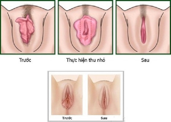 Thu hẹp âm đạo