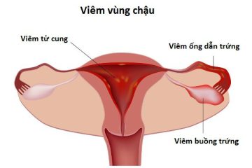 [ Tổng hợp ] 6 + Nguyên nhân viêm vùng chậu tưởng lạ nhưng lại quen