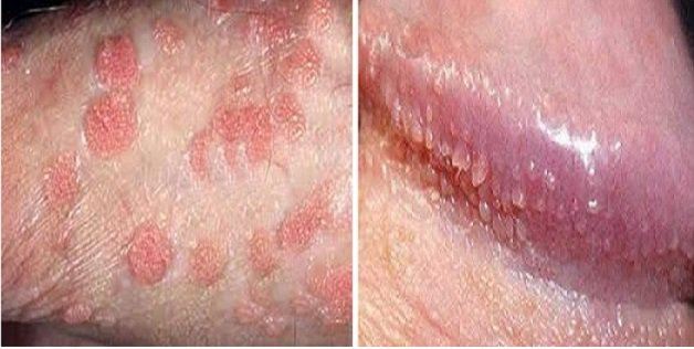 dương vật nổi mụn