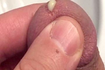 Đầu dương vật chảy mủ trắng [ Là bệnh gì?] [Có nguy hiểm không?]