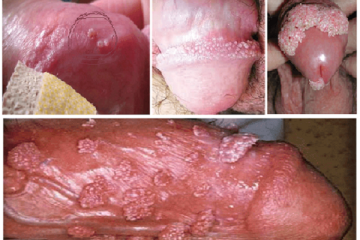 [ Nổi mụn ngứa ở dương vật ] là bệnh gì? Cùng nghe chuyên gia giải đáp