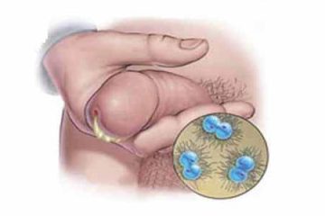 [Bật mí] 5+ Cách điều trị dương vật bị chảy mủ