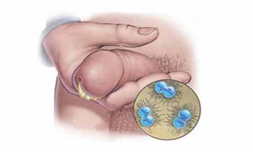 Cách điều trị dương vật bị chảy mủ