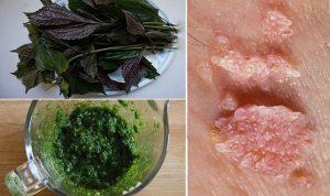 Bệnh sùi mào gà có chữa được không?