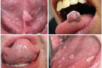 [ Tìm hiểu ] Bệnh sùi mào gà ở lưỡi cùng [ chuyên gia ]