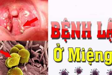 [GIẢI ĐÁP] Bệnh lậu trong miệng có nguy hiểm không. Có tự khỏi không?