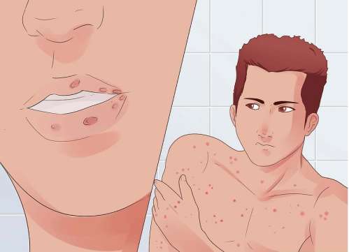 Bệnh lậu và sùi mào gà