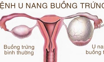 Bệnh u nang buồng trứng là gì? [Vần đề chị em quan tâm]