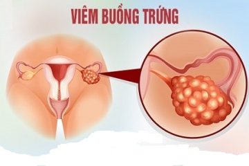 [Viêm buồng trứng là gì]: Dấu hiệu, nguyên nhân & cách điều trị