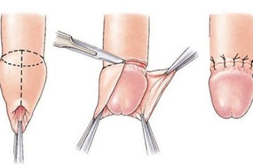 [Chuyên gia giải đáp]: Cắt bao quy đầu như thế nào?