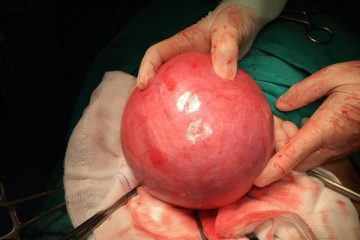 Nữ bệnh nhân 33 tuổi khó có con vì coi thường u xơ tử cung