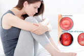 Sống chung với viêm lộ tuyến cổ tử cung 3 năm – Tôi đã chữa khỏi bằng phương pháp này